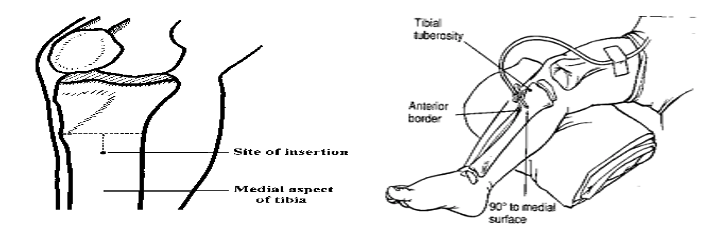INTRA-OSSEOUS INFUSION IN EMERGENCIESg