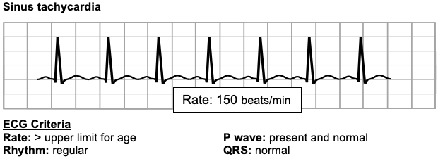 Sinus tachycardia