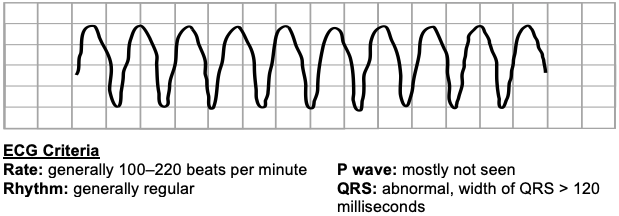 Ventricular tachycardia