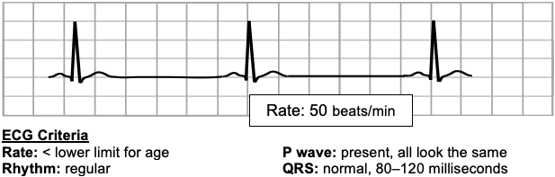 Sinus bradycardia